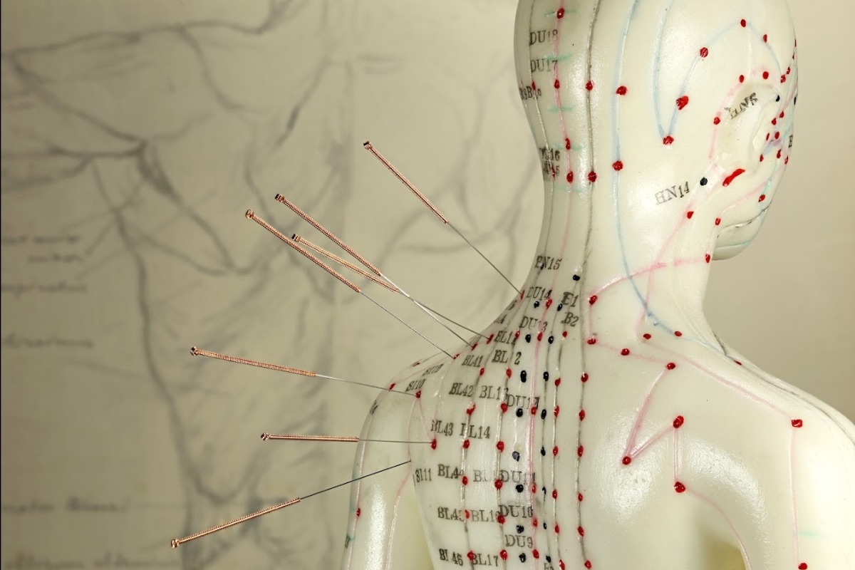 Benefícios Da Acupuntura Neurovida Jmg 2647